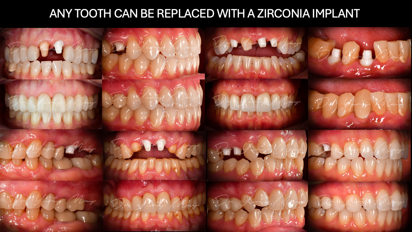 Dr. May zirconia implant before and after: titled collage of eight paired cases, each showing zirconia implant abutments at placement above and the final restored teeth below, covering single anterior, multiple anterior and premolar sites.