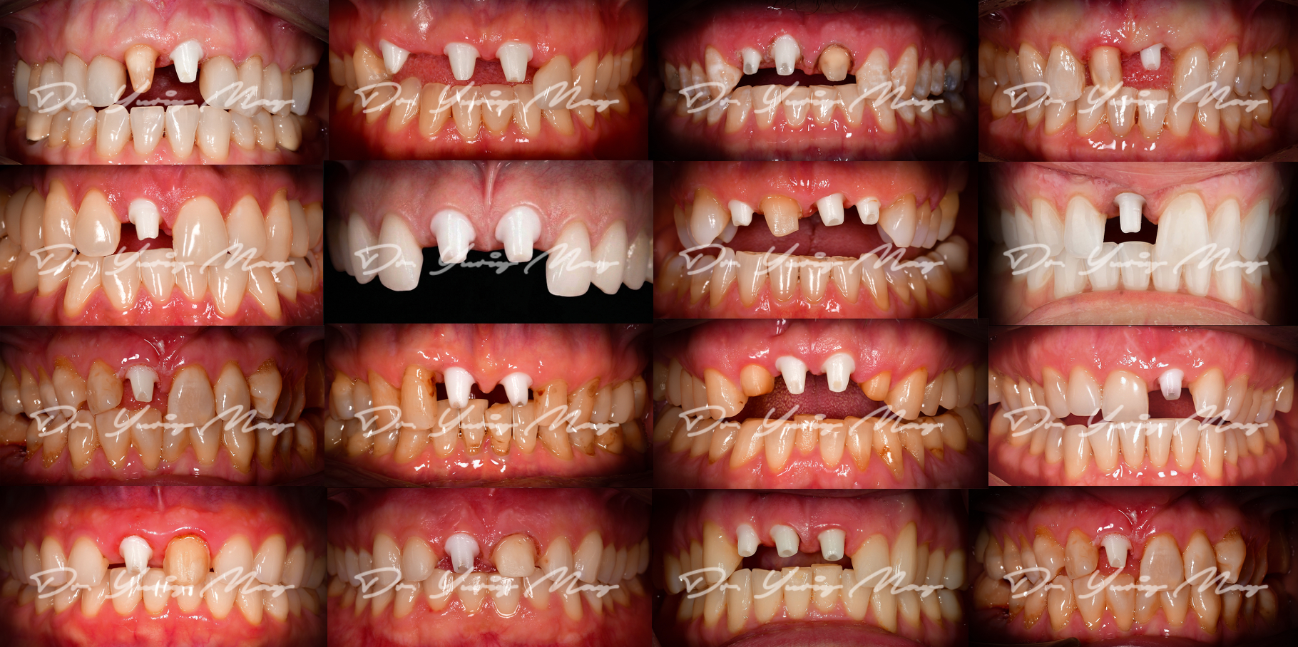 Dr. May zirconia implant before and after: placement-stage collage of sixteen anterior cases showing single and multiple one-piece zirconia implant abutments in the upper front teeth; restorations are not shown.