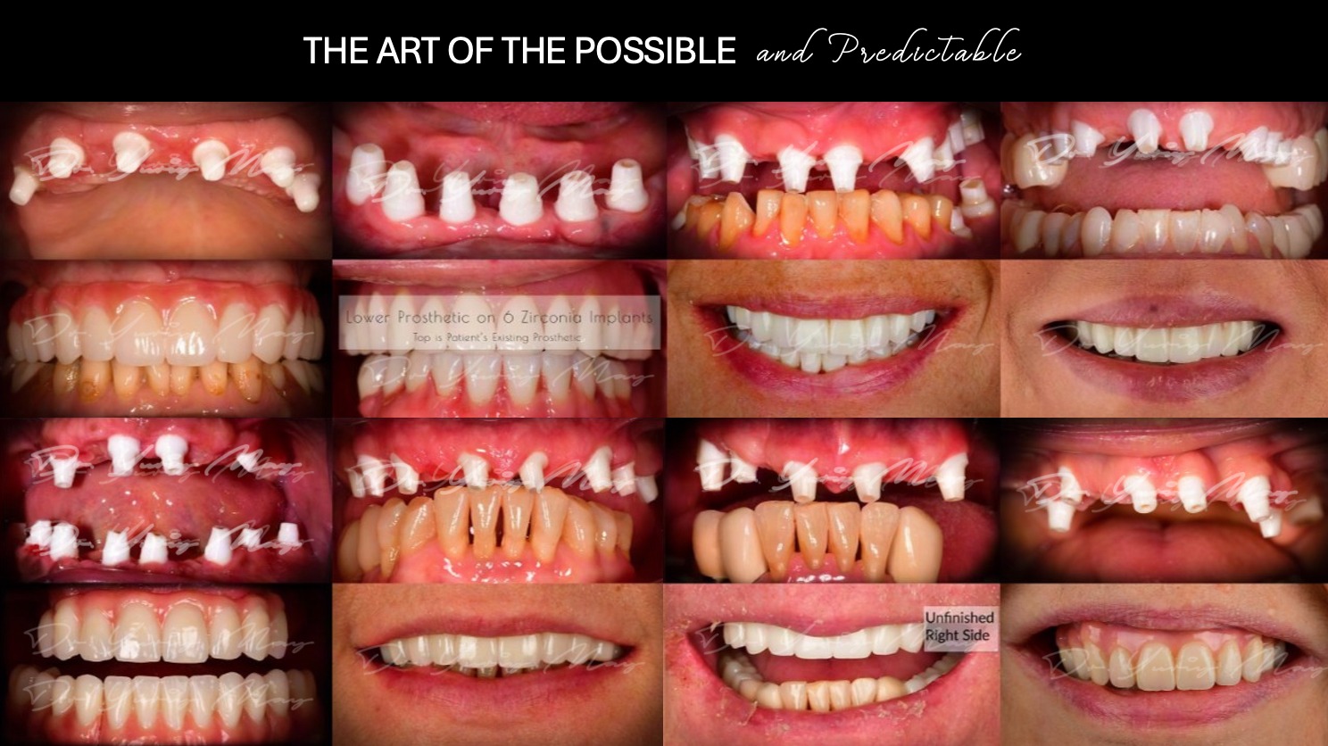 Dr. May zirconia implant before and after: titled full-arch collage comparing multiple zirconia implants at placement with the restored arches and smiles, including a lower prosthetic on six zirconia implants and one case labeled unfinished right side.