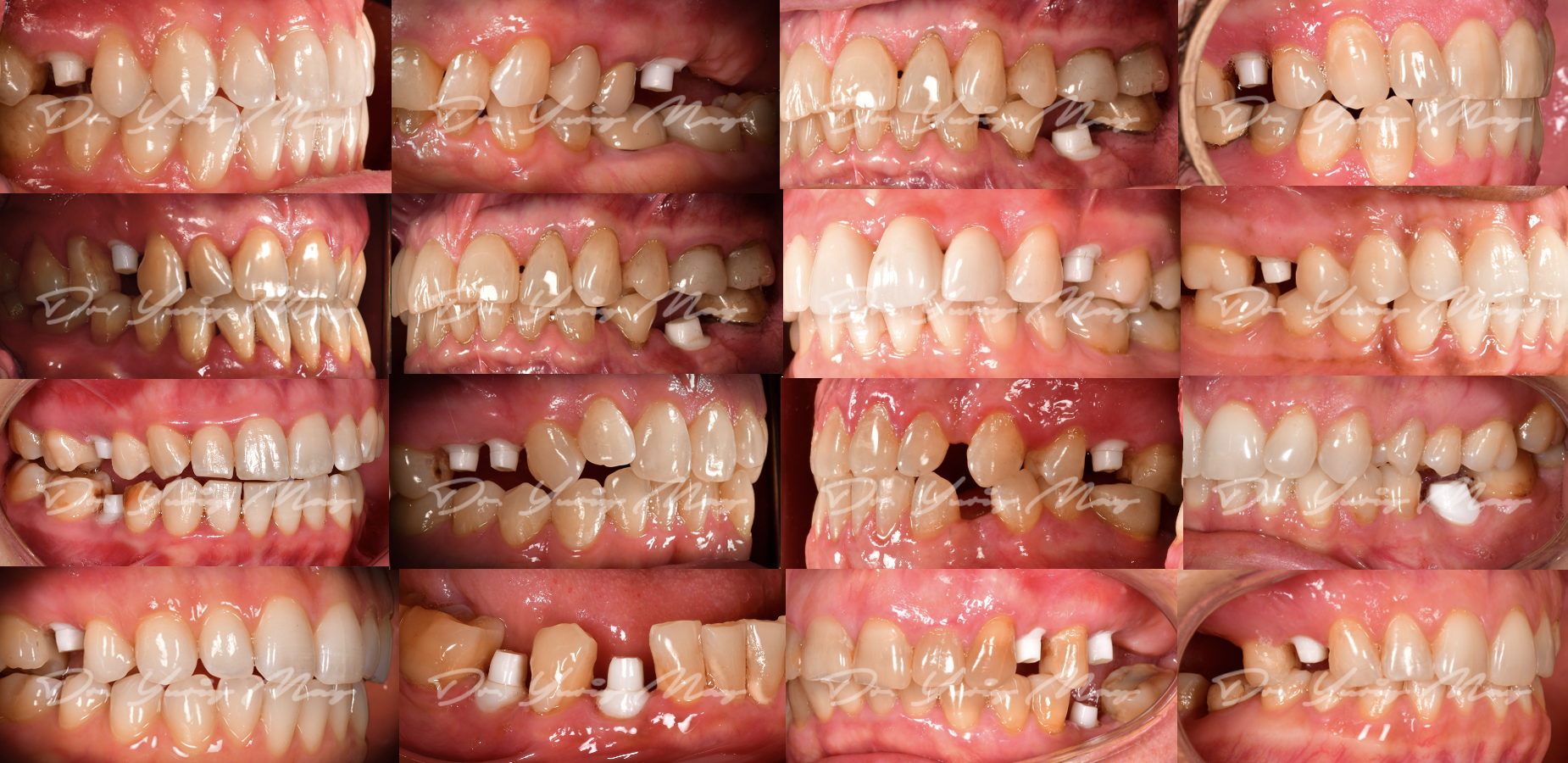 Dr. May zirconia implant before and after: multi-case grid of sixteen lateral views showing posterior zirconia implant abutments placed in premolar and molar sites of the upper and lower jaws, at the placement stage.